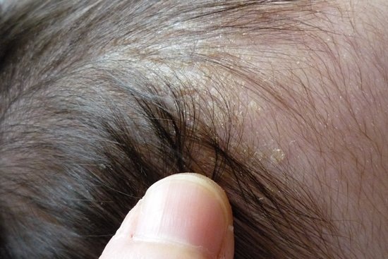 Round Red Patch On Scalp